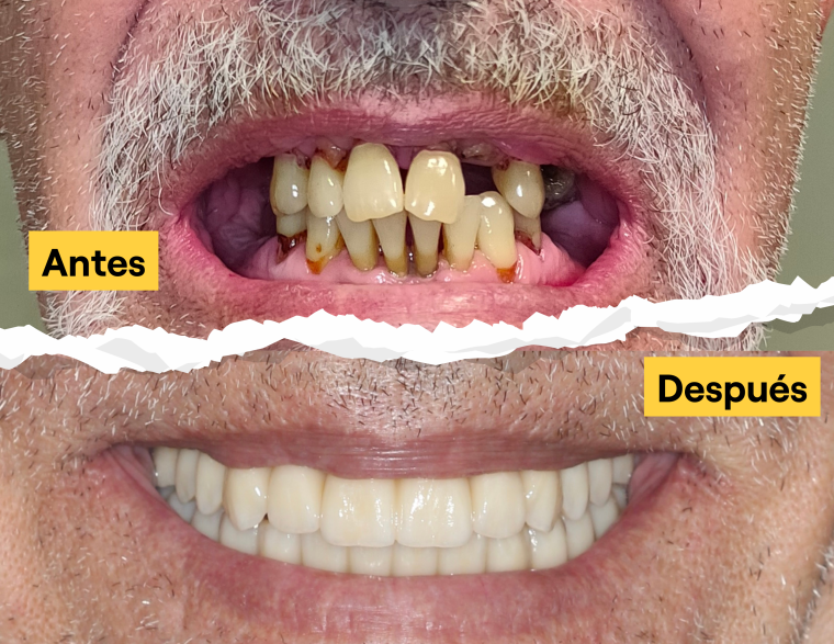 IOC one-Day-6: Dientes fijos sobre solo 6 implantes [PRENSA]