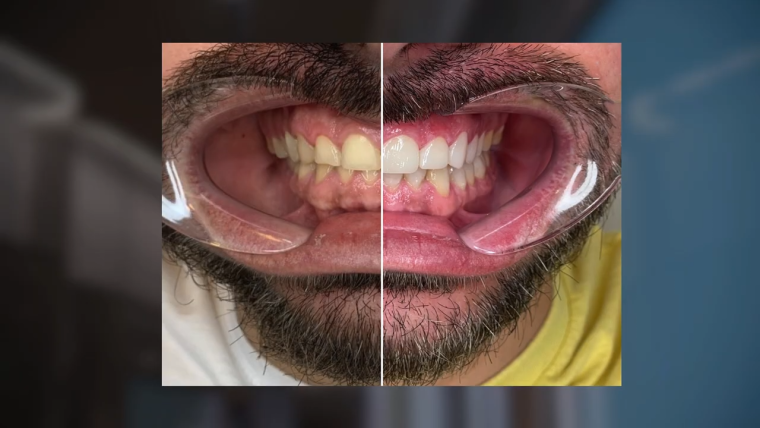 Antes-después de un Tratamiento de Carillas de Porcelana con el método guiado ¡en 24h! [VÍDEO]