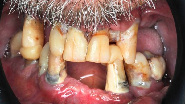 Implantes y Dientes Fijos en 24h