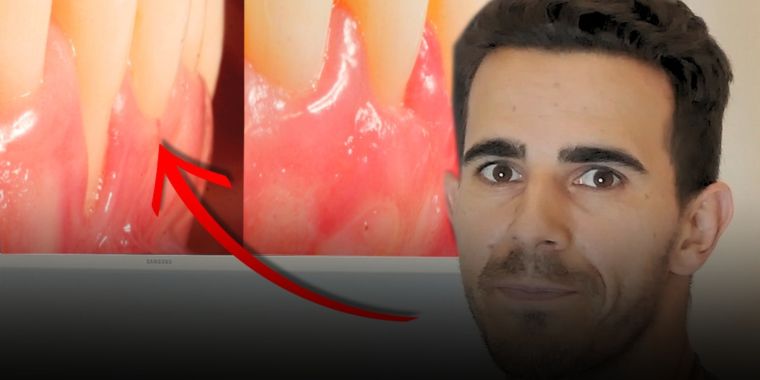 Recesión gingival y tratamientos