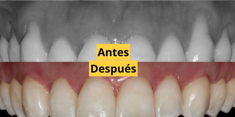 Recesión gingival y tratamientos