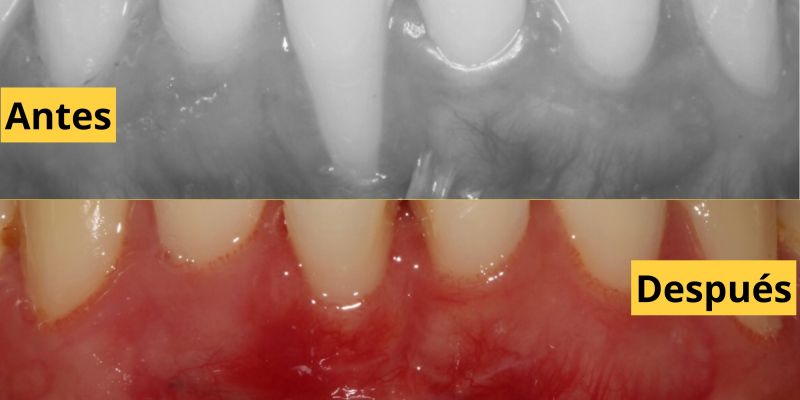 Recesión gingival y tratamientos