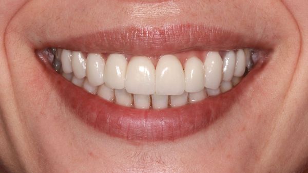 Estética dental con carillas de porcelana