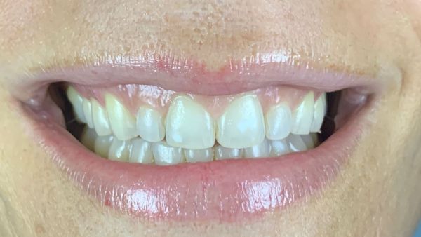 Mejora la estética dental con carillas de porcelana