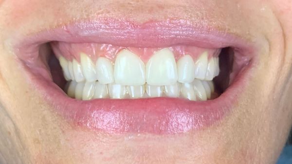 Mejora la estética dental con carillas de porcelana