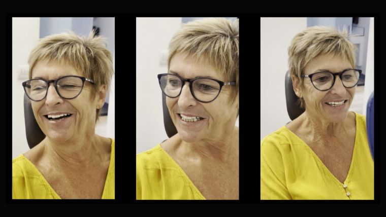 Testimonio de Christine tras su tratamiento de implantes cigomáticos [VÍDEO]