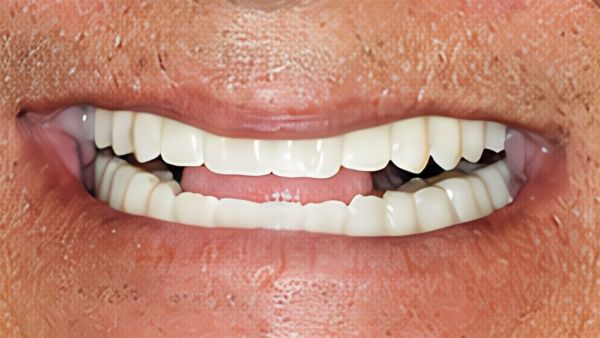 Implantes y Dientes Fijos en 24h