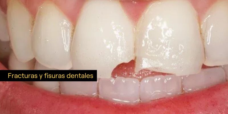 Consecuencias de los piercings orales para la salud bucal