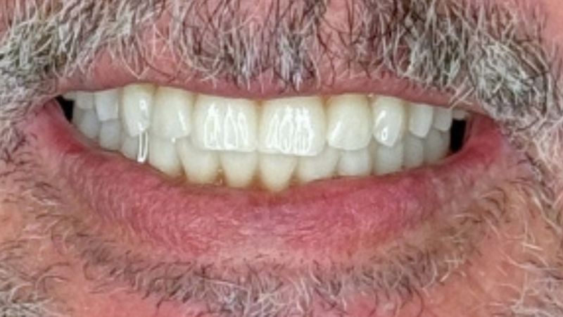 Sin dolor, sin miedo y en un día: cómo Francisco volvió a sonreír