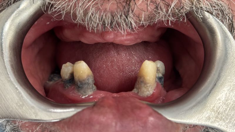 Sin dolor, sin miedo y en un día: cómo Francisco volvió a sonreír