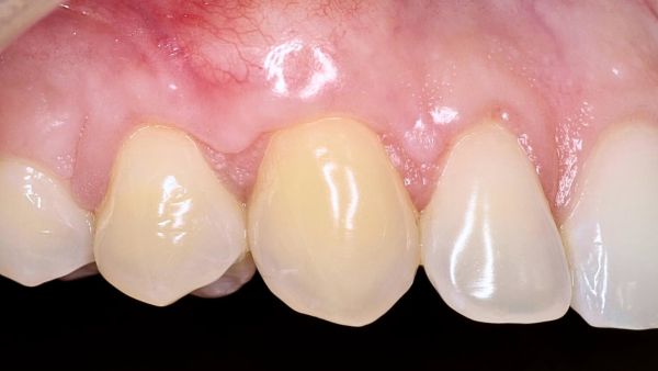 La cirugía mucogingival mínimamente invasiva