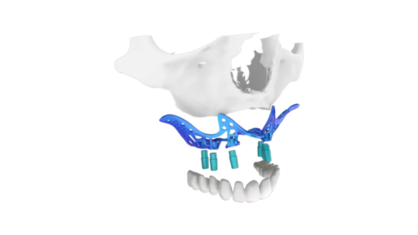Implantes yuxtaóseos (subperiósticos)