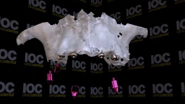 Dientes fijos en 24h con solo 6 implantes