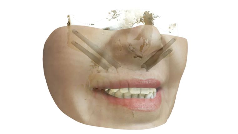 ¿Existe solución de implantes si tengo poco hueso maxilar? Implantología Cigomática