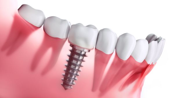 Implantes y dientes fijos en 24 horas