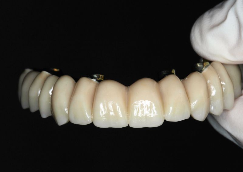 Implantes dentales de zirconio: la combinación perfecta entre estética y funcionalidad