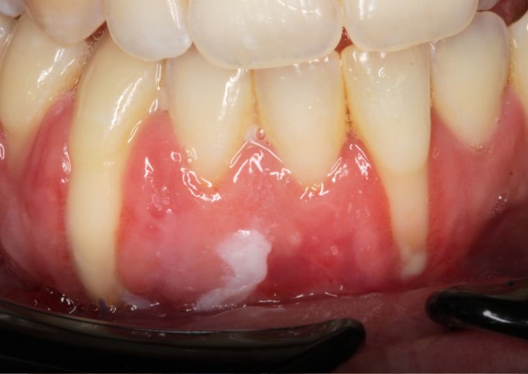 Ortodoncia Invisible: ¿Por qué es esencial la supervisión profesional?
