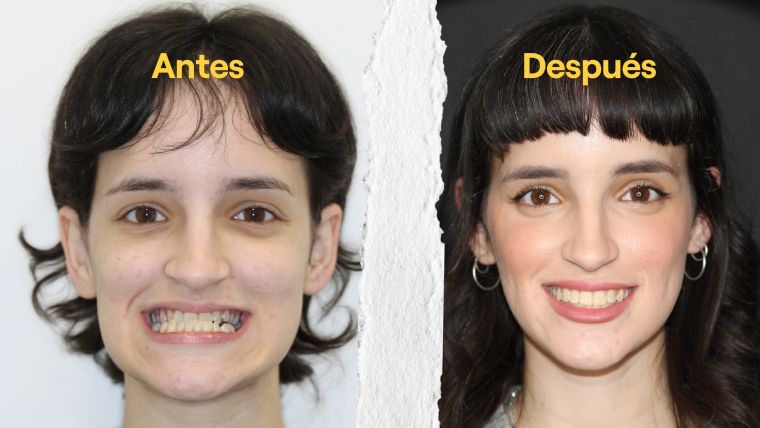 Testimonio de Karen tras su tratamiento de ortodoncia quirúrgica y cirugía ortognática [VÍDEO]