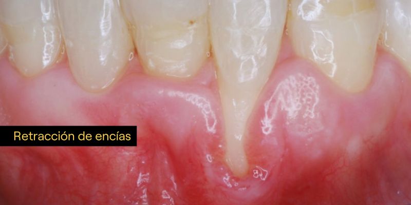 Consecuencias de los piercings orales para la salud bucal