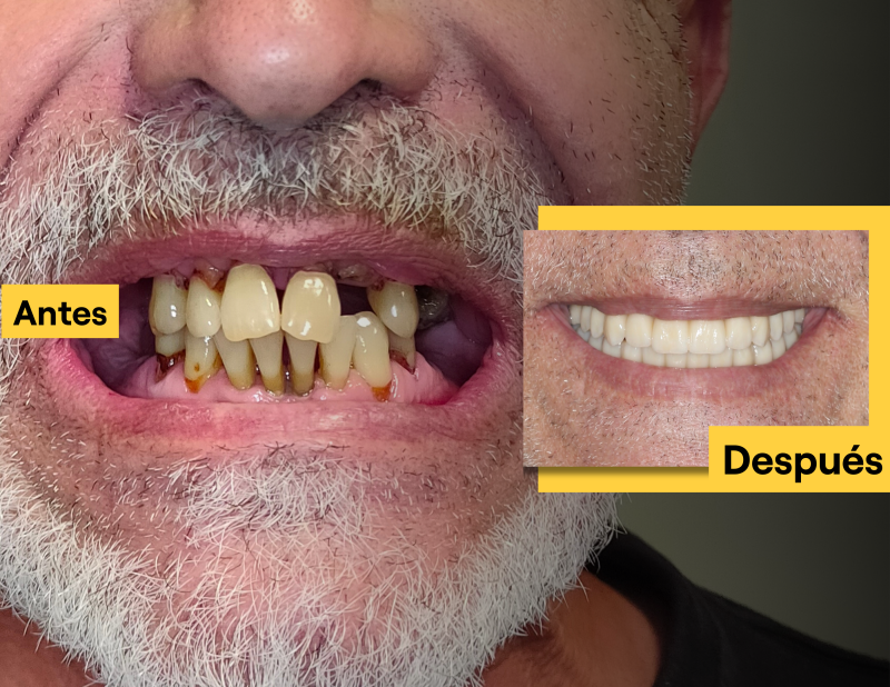 IOC one-Day-6: Dientes fijos sobre solo 6 implantes [PRENSA]