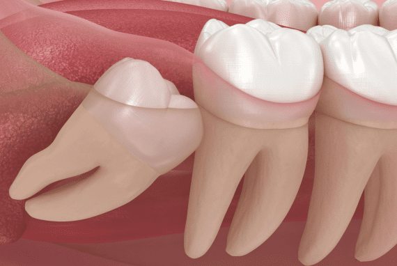 Muelas del juicio o Cordales - Causas y soluciones 