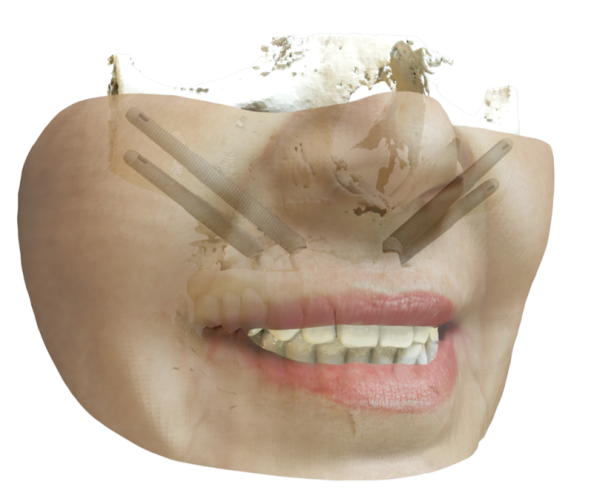 Implantología cigomática