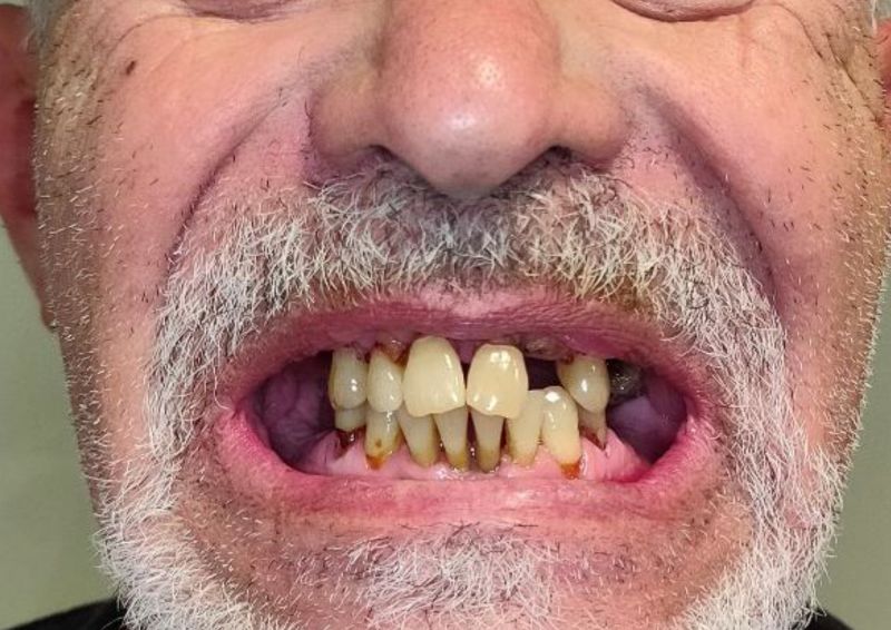 Implantes Dentales Fijos en 24 Horas en Gran Canaria: "Recuperamos tu Sonrisa con total confianza”