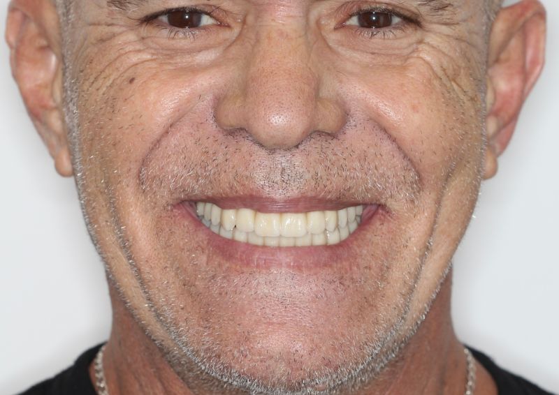 Implantes Dentales Fijos en 24 Horas en Gran Canaria: "Recuperamos tu Sonrisa con total confianza”